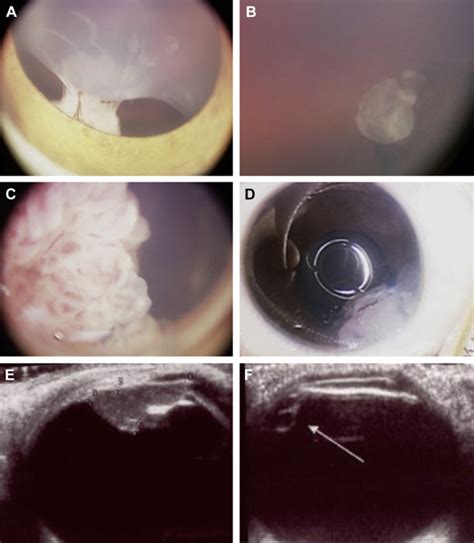ruthenium lump|106 Ruthenium eye plaque brachytherapy in the management of .